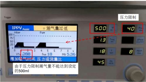 呼吸機5種模式不會選擇？看完這篇你就懂了——ST模式詳解